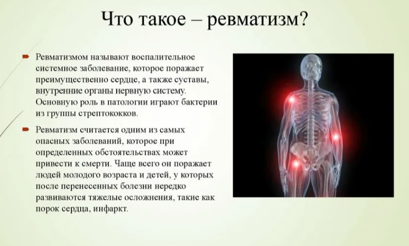 Ревматизм